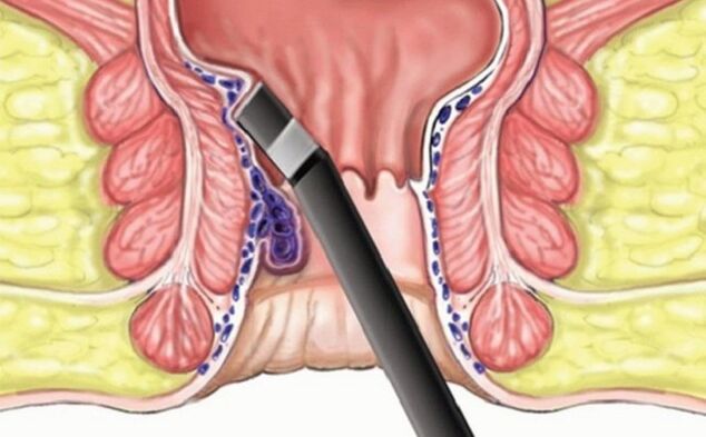 blood clot hemorrhoids